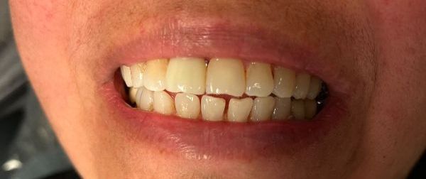 After Dental Implants