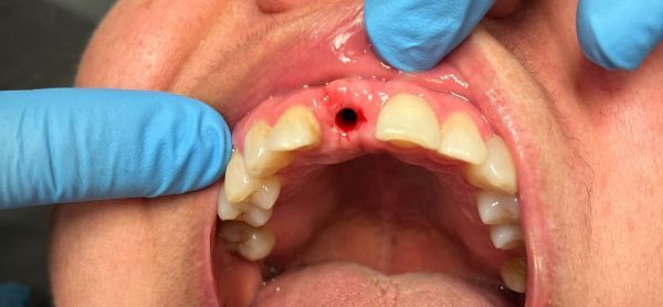 Before Dental Implants