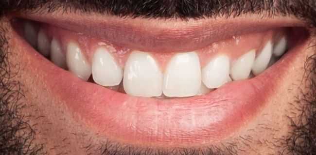 Después Blanqueamiento dental