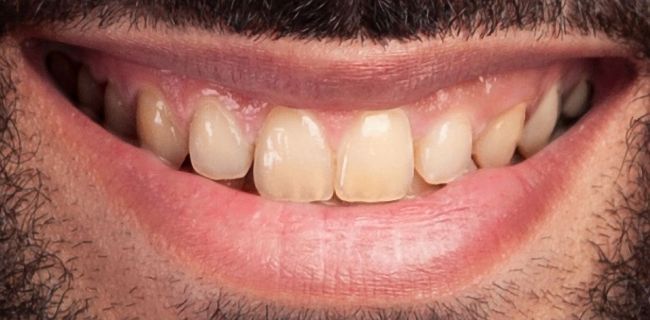 Antes Blanqueamiento dental