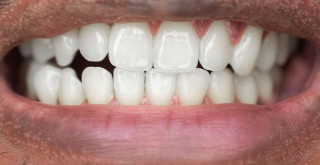 Después Blanqueamiento dental