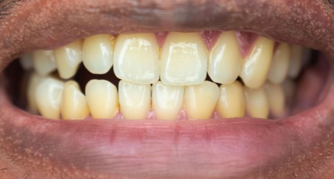 Antes Blanqueamiento dental