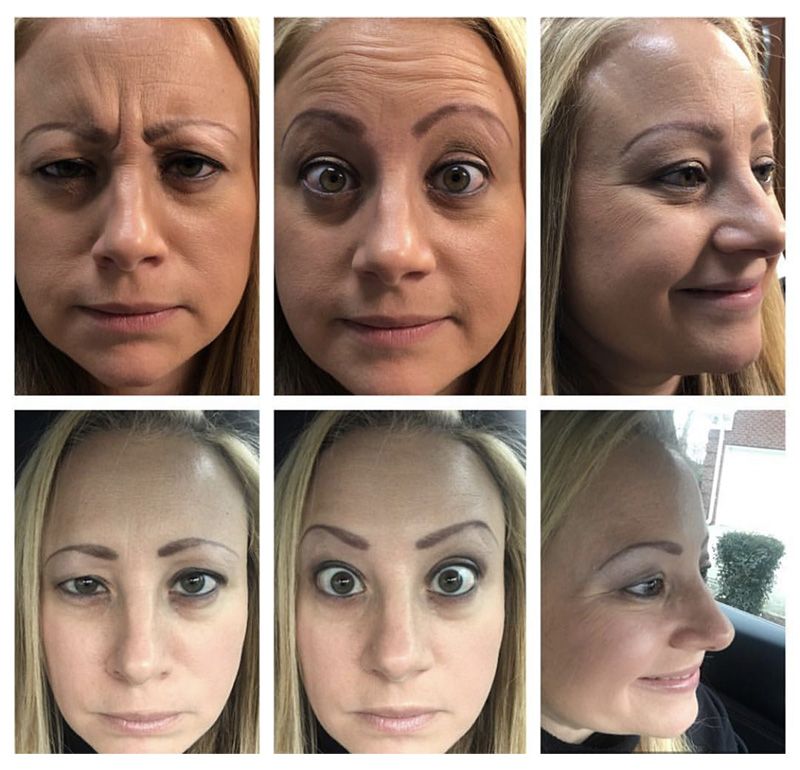 A woman 's face is shown before and after a facial treatment