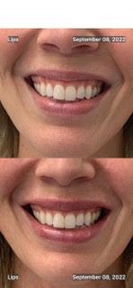 A before and after picture of a woman's smile.Fillers