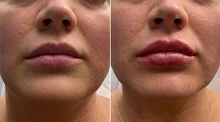 A before and after photo of a woman's lips. Fillers