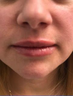 A close-up of a woman's lips and nose. Fillers