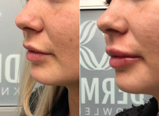 A before and after photo of a woman's lips.Fillers