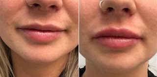 A before and after photo of a woman's lips with a nose ring. Fillers