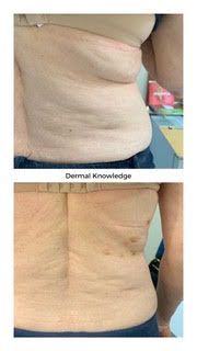 A before and after picture of a woman 's back.