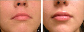A before and after photo of a woman's lips. Fillers