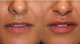 A before and after picture of a woman 's lips. Fillers