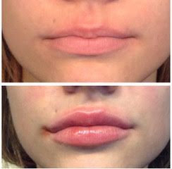 A before and after picture of a woman's lips. Fillers