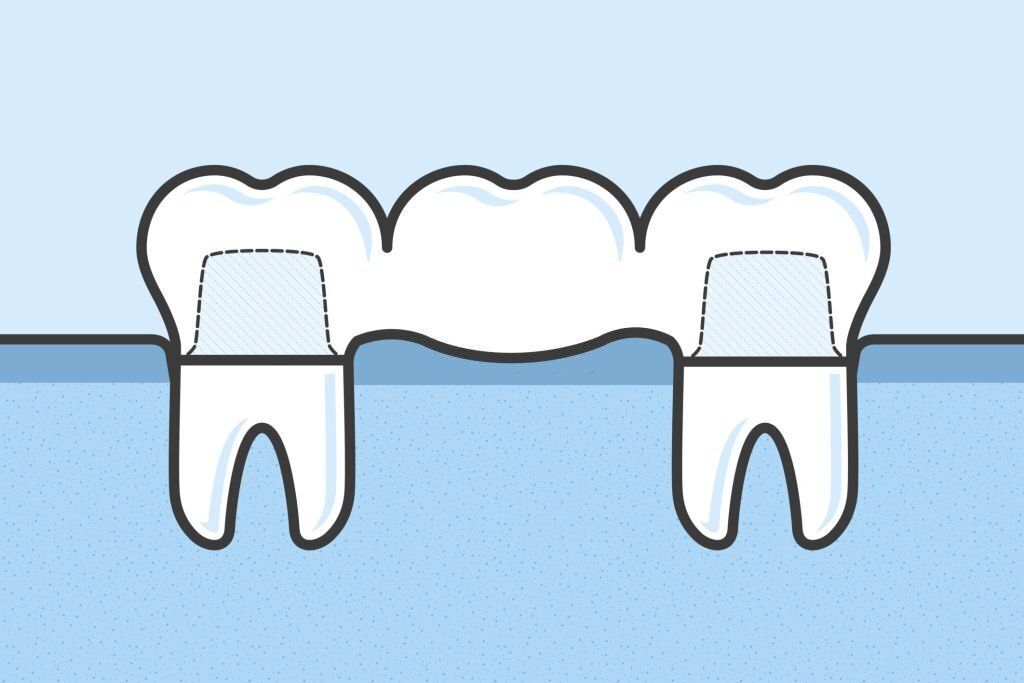 Treatment for Teeth Replacement