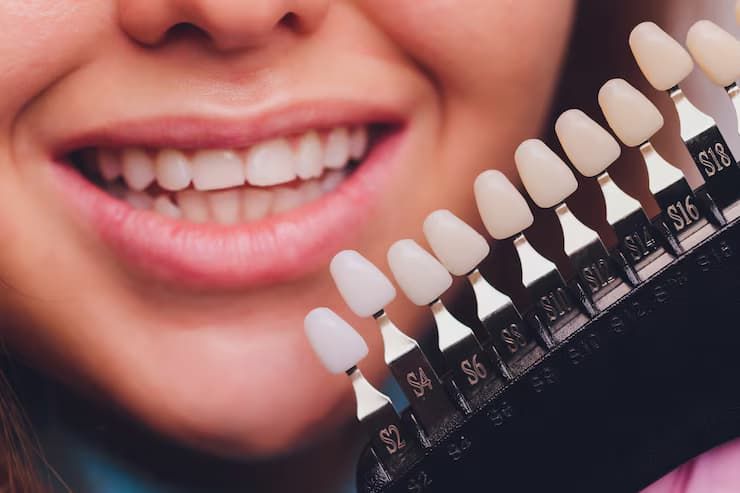 veneers in Richmond