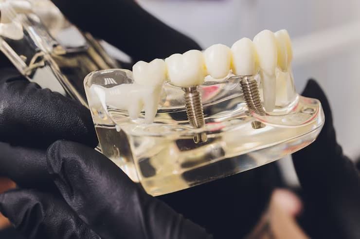 dental implants