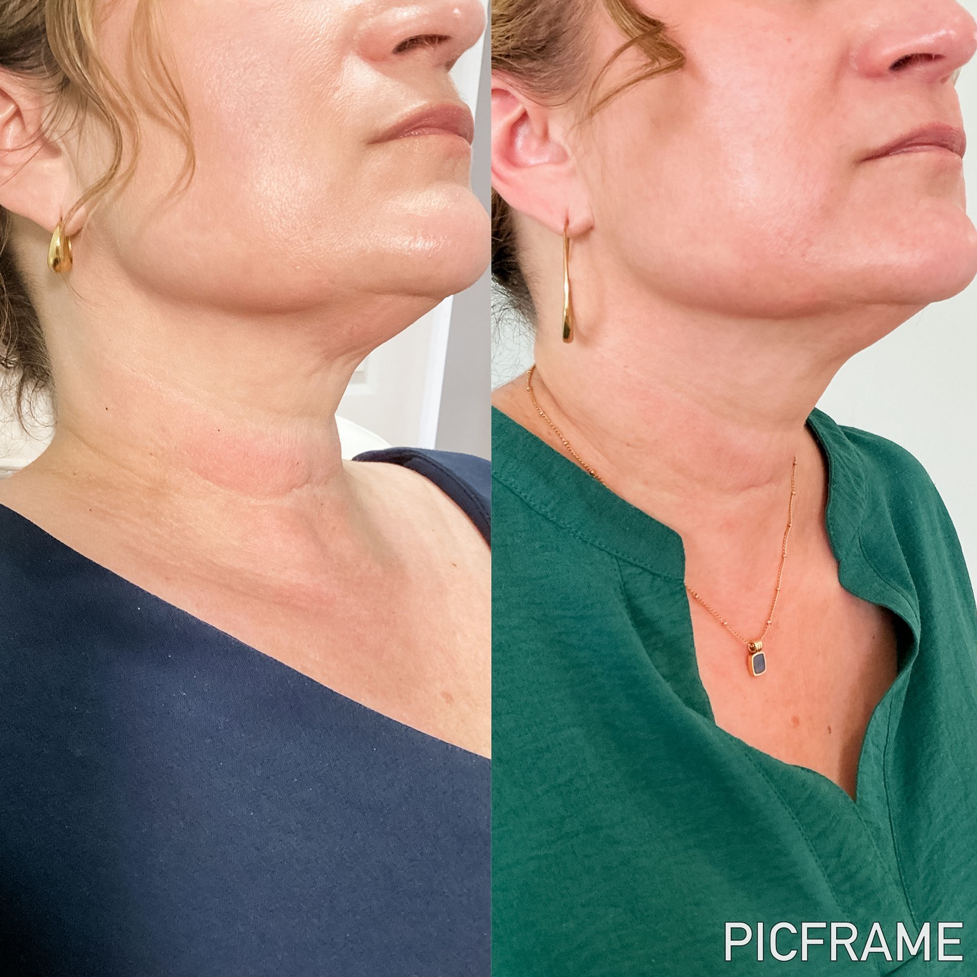 Side-by-side comparison of a person's neck and jawline, before and after a treatment, with reduced double chin appearance.