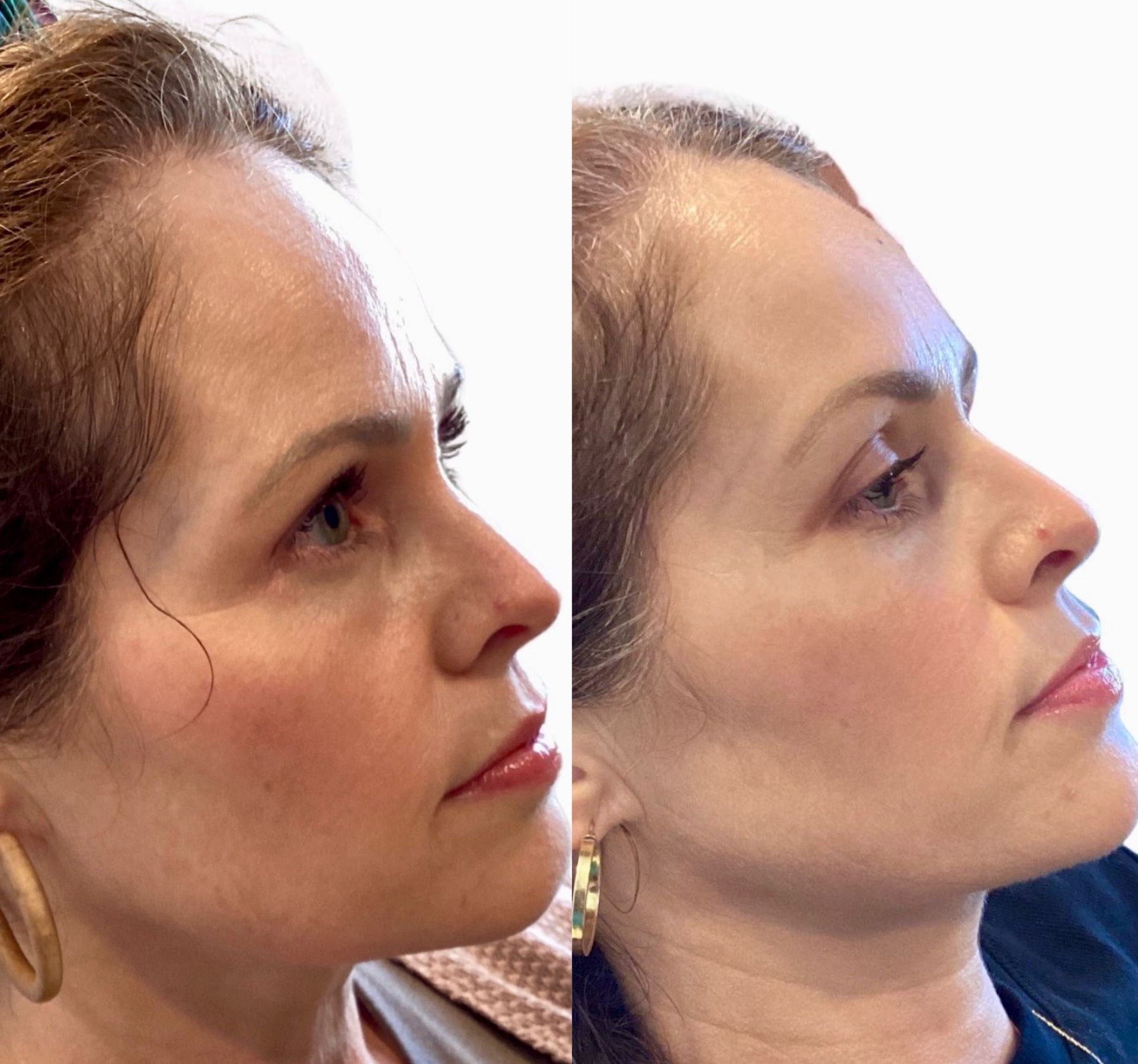 Side-by-side photos of a person's profile before and after a cosmetic procedure, showing smoother skin.