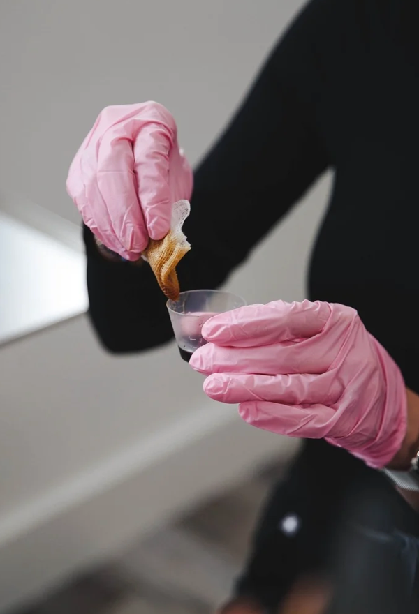 Chemical peel for acne scars and texture improvement