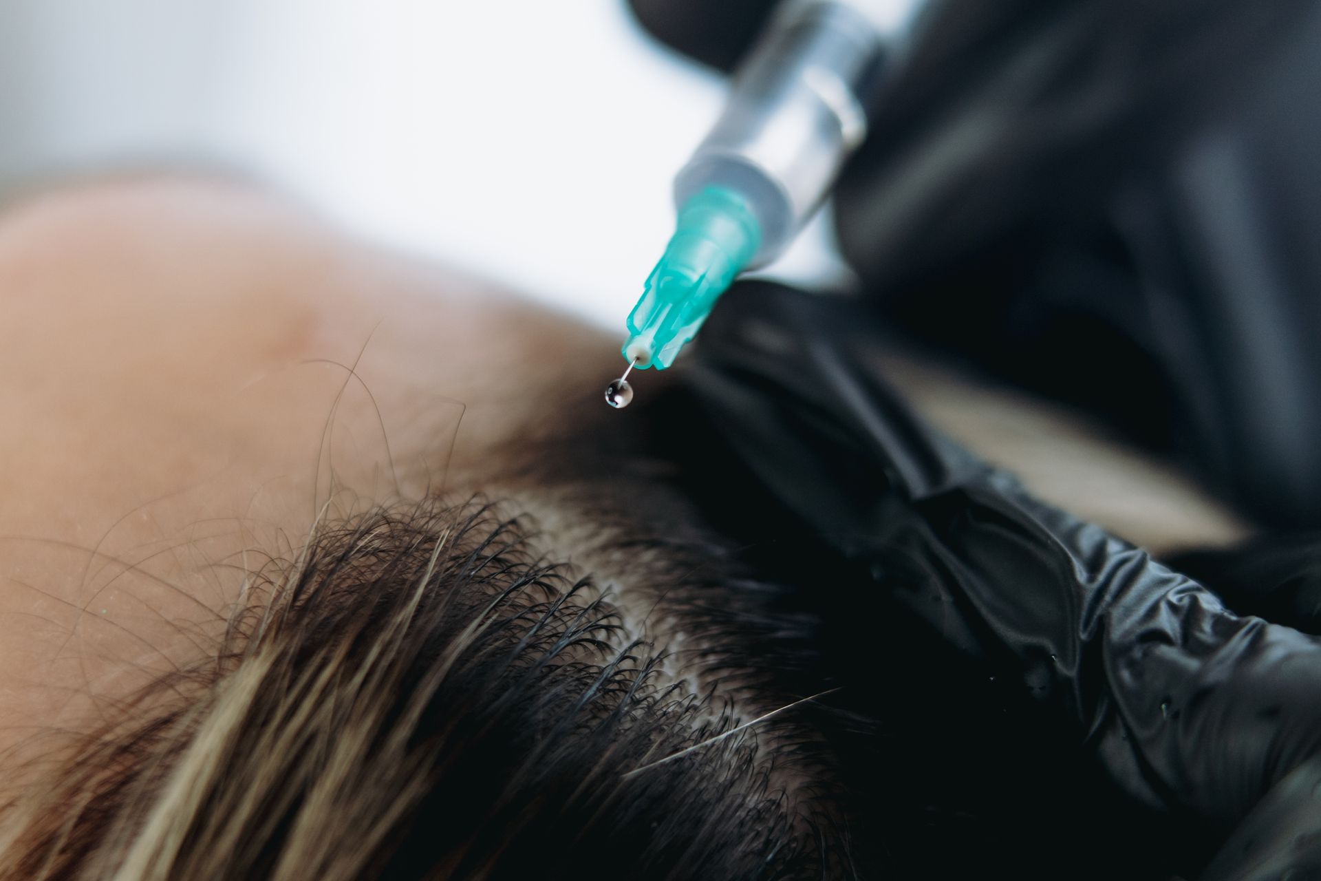 Person receiving scalp injection with a syringe held by a gloved hand.