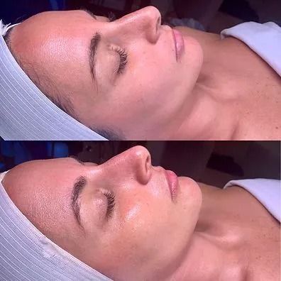 Two photos: woman with eyes closed, undergoing facial treatment, lying down.