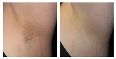 Two underarm views: one with dark hair, one hair-free, suggesting hair removal.
