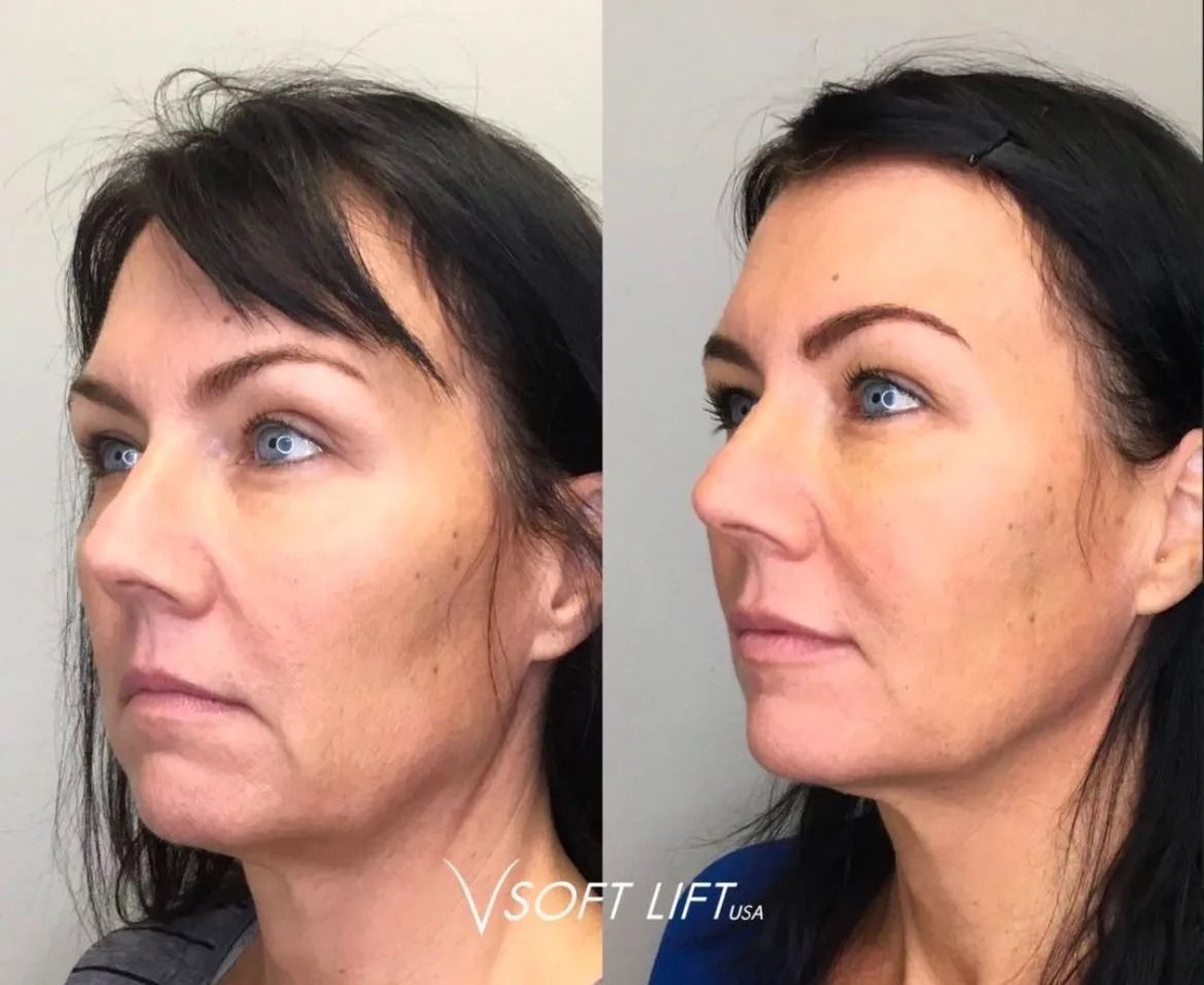 Left side shows woman's face before treatment.