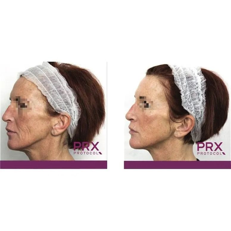 Side-by-side comparison: woman's face before and after PRX-T33 treatment. Skin appears smoother, with reduced wrinkles.