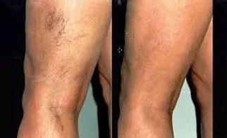 Legs showing the before and after appearance of varicose veins after treatment.