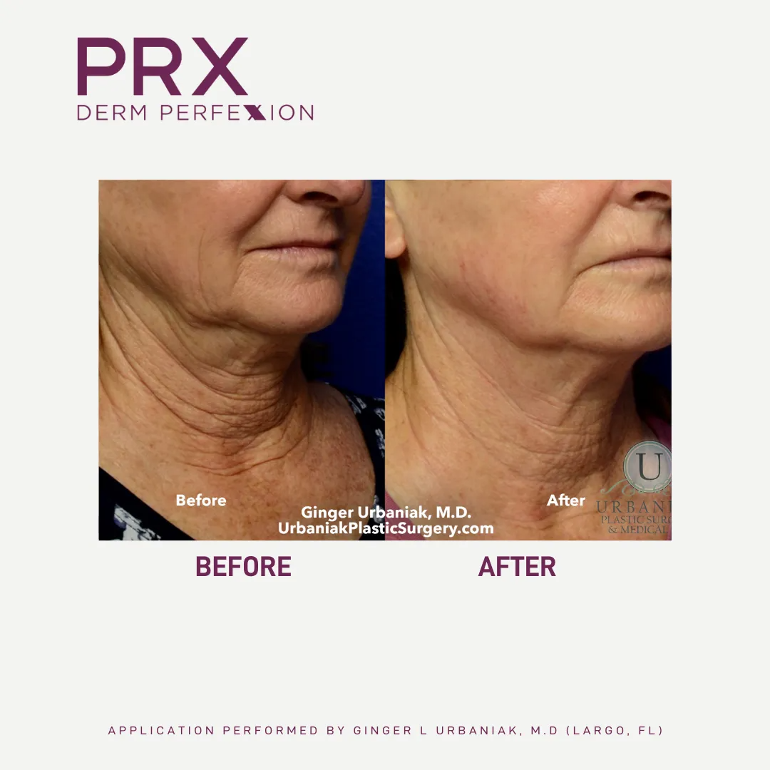 Before and after photos of a neck. The “before” photo shows wrinkles. The “after” photo shows a smoother neck.