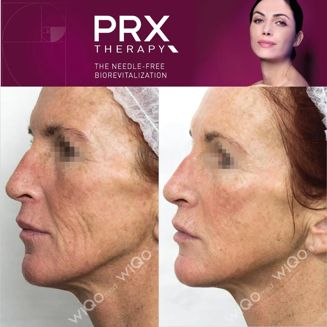 Before and after photos of a woman's face, showing wrinkle reduction after PRX-T33 therapy.