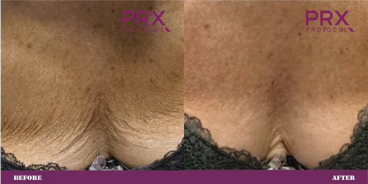 Side-by-side comparison of skin on the upper chest. 