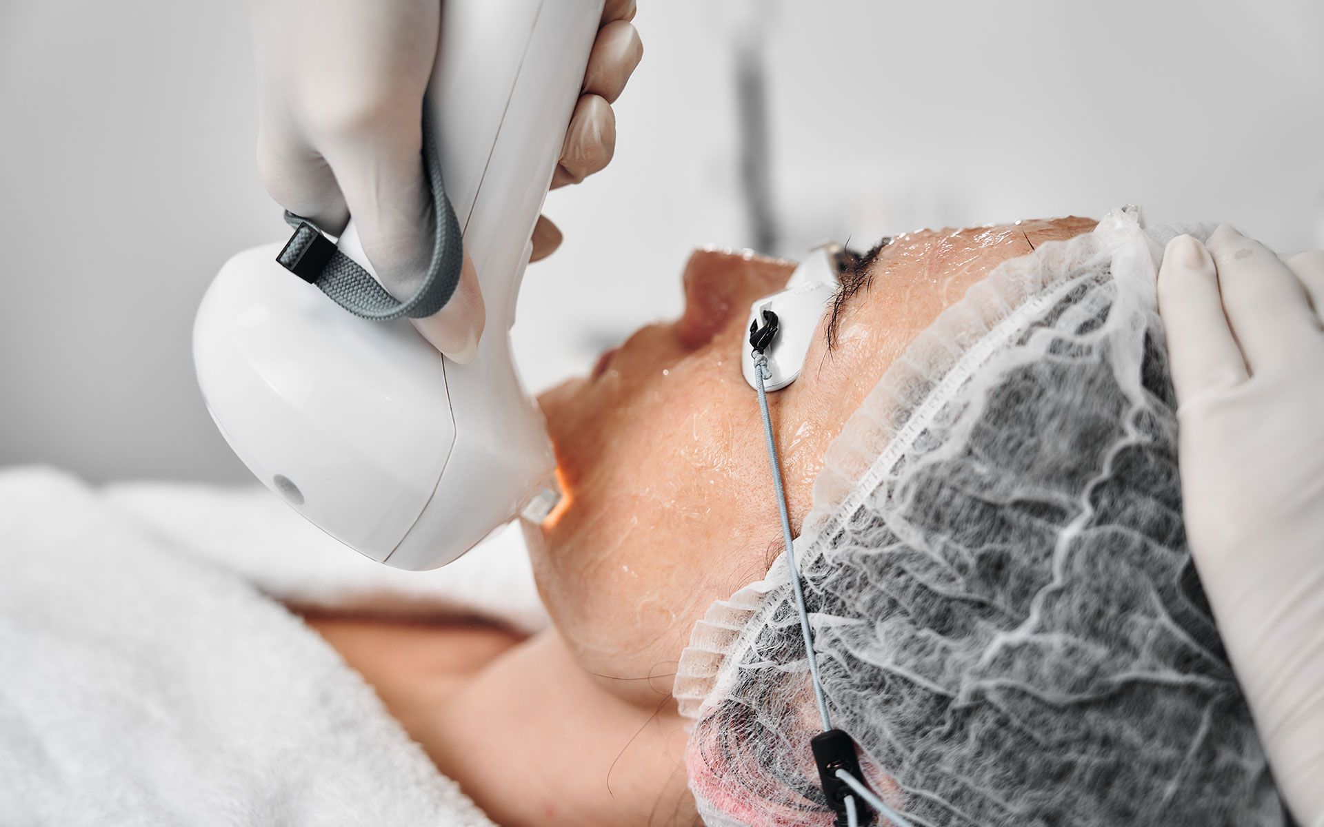 Person receiving laser skin treatment on face, in a medical setting, with protective eyewear and gloves.