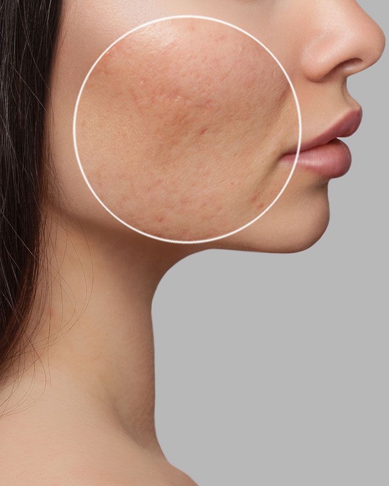 Woman's face in profile, with skin imperfections highlighted by a white circle, against a gray backdrop.