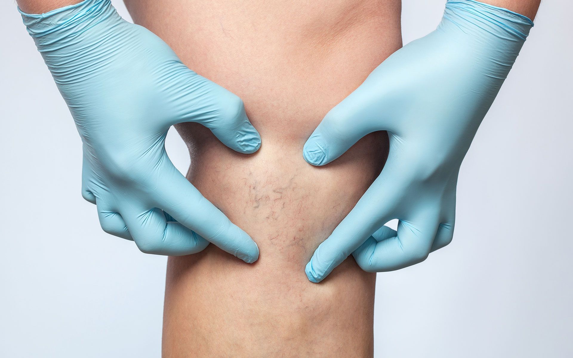 Hands in blue gloves examining a knee, pointing at the area.