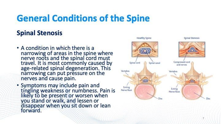 Spinal Stenosis images