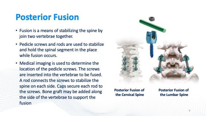 posterior-fusion-slide