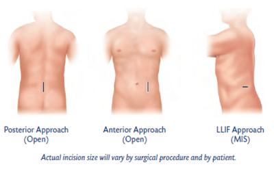 minimally invasive spine surgery approach diagram