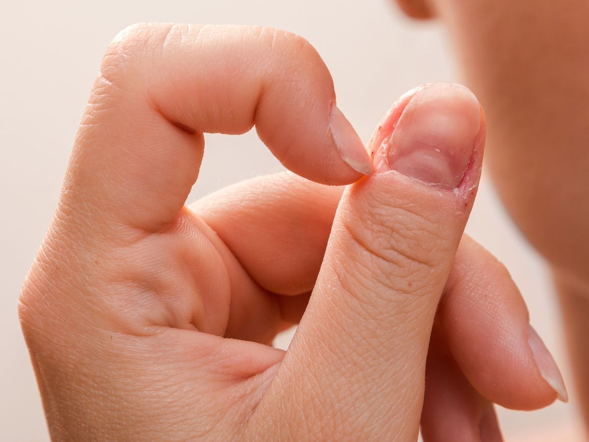 A close-up of a person's hand showing bad cuticle health.