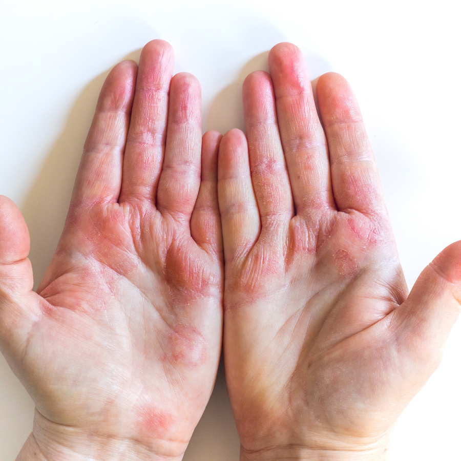 Allow Nourishment / A close-up of a person's hands with eczema on them.