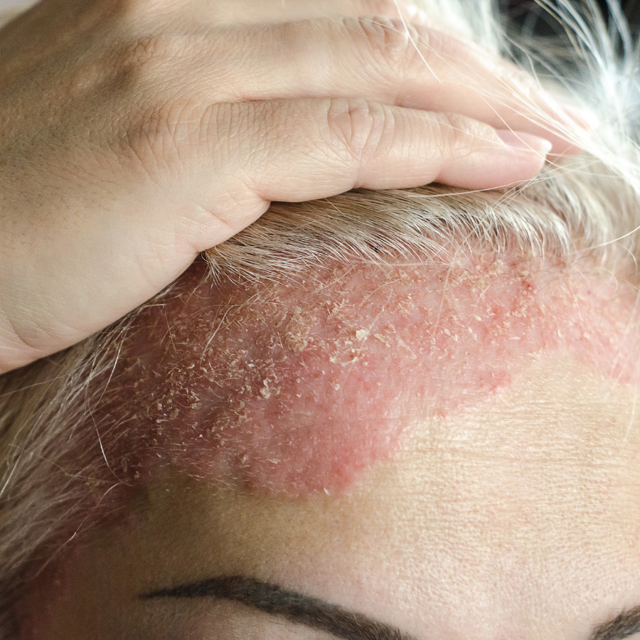 Allow Nourishment / A close-up of a person's head with psoriasis.