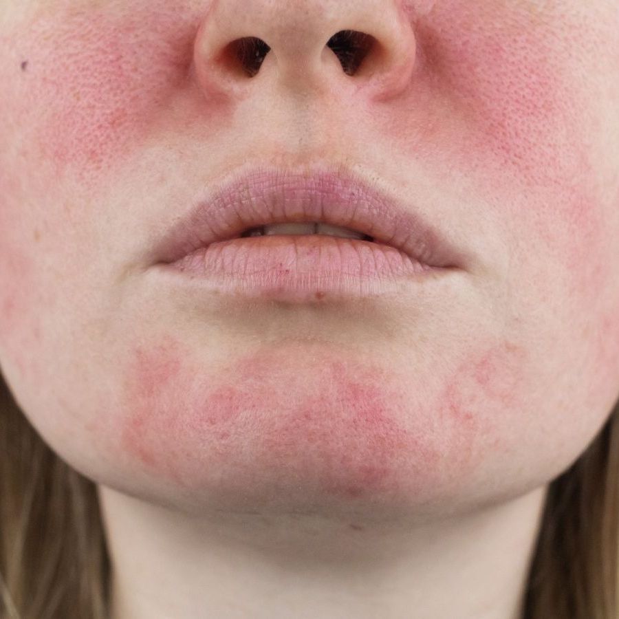 A close-up of a woman's face with windburn.