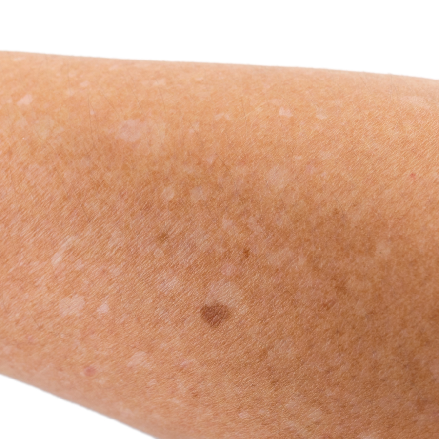 A close-up of a person's arm with a dark spot on it.