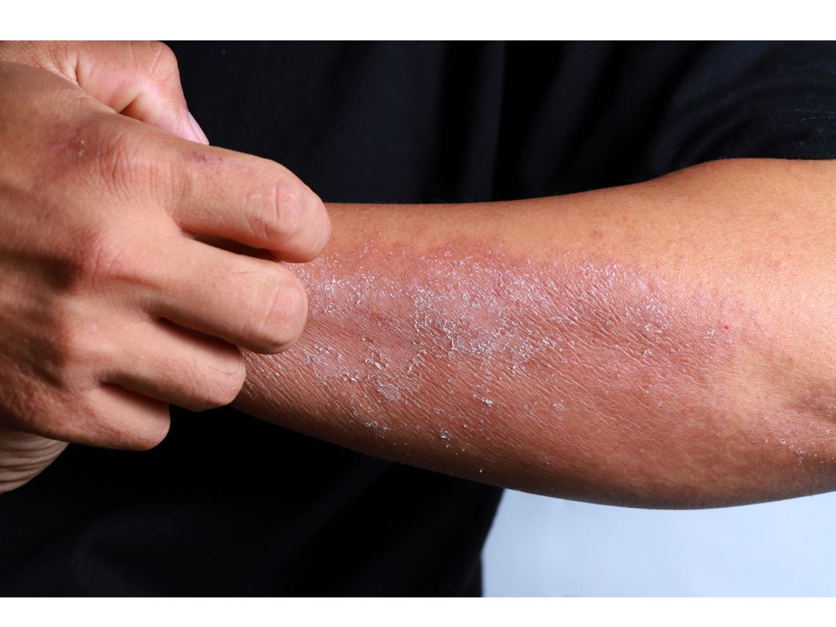 A picture of a mans forearm being inflammed and Allow Nourishments tallow face and body cream being a solution to help heal