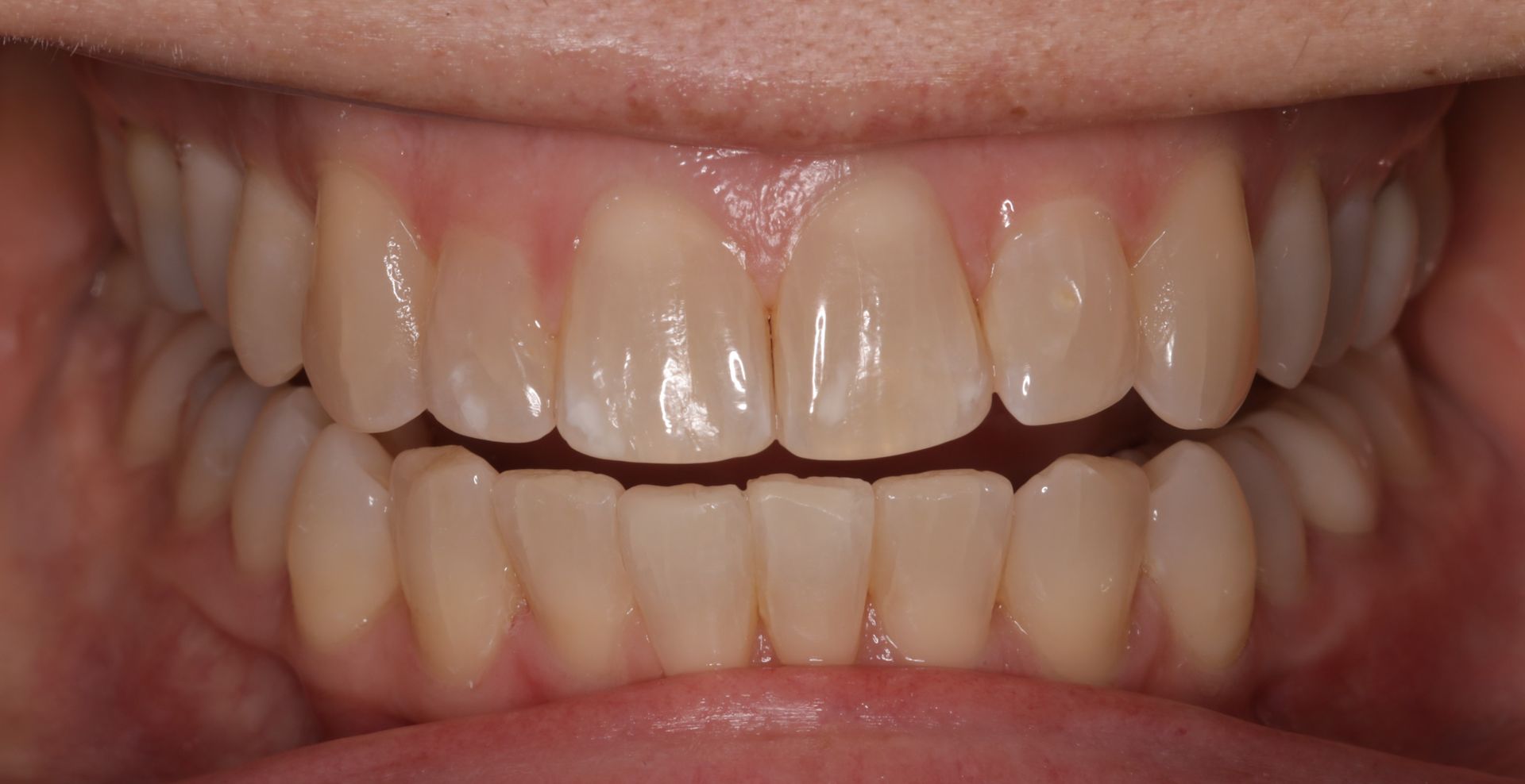 A close up of a person 's teeth with white teeth.