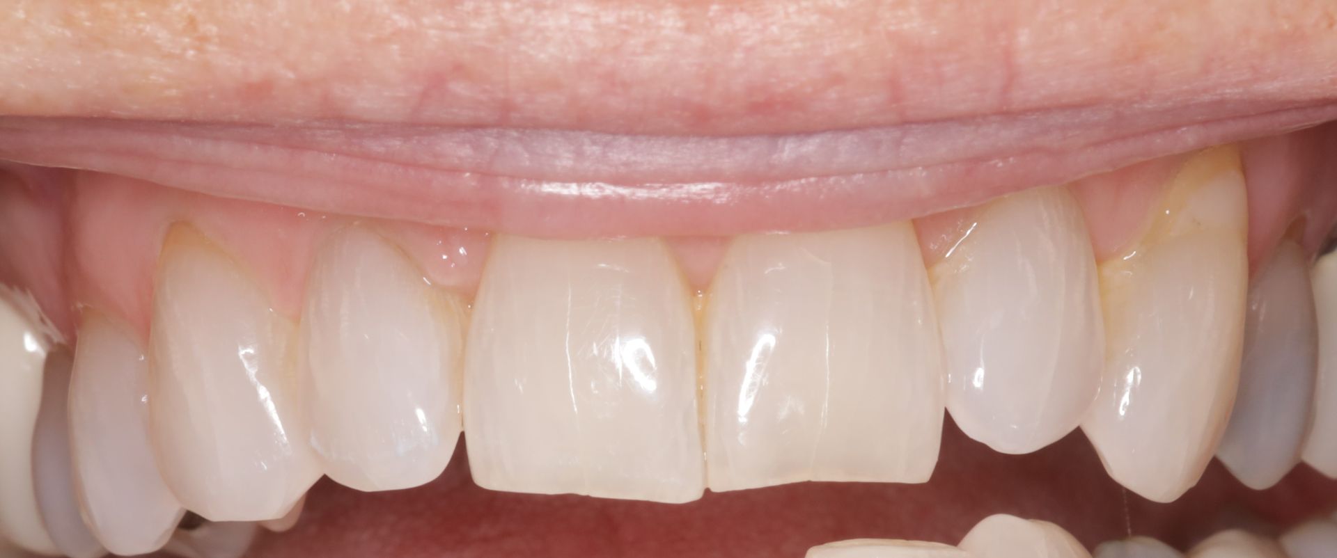 A close up of a person 's teeth with a broken tooth.