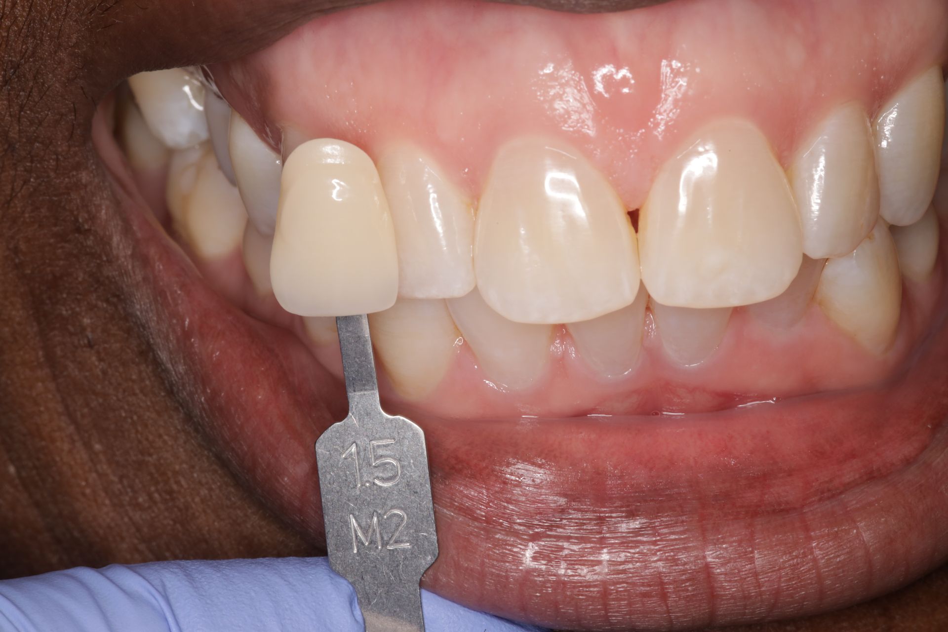 A close up of a person 's teeth with a tooth color chart.