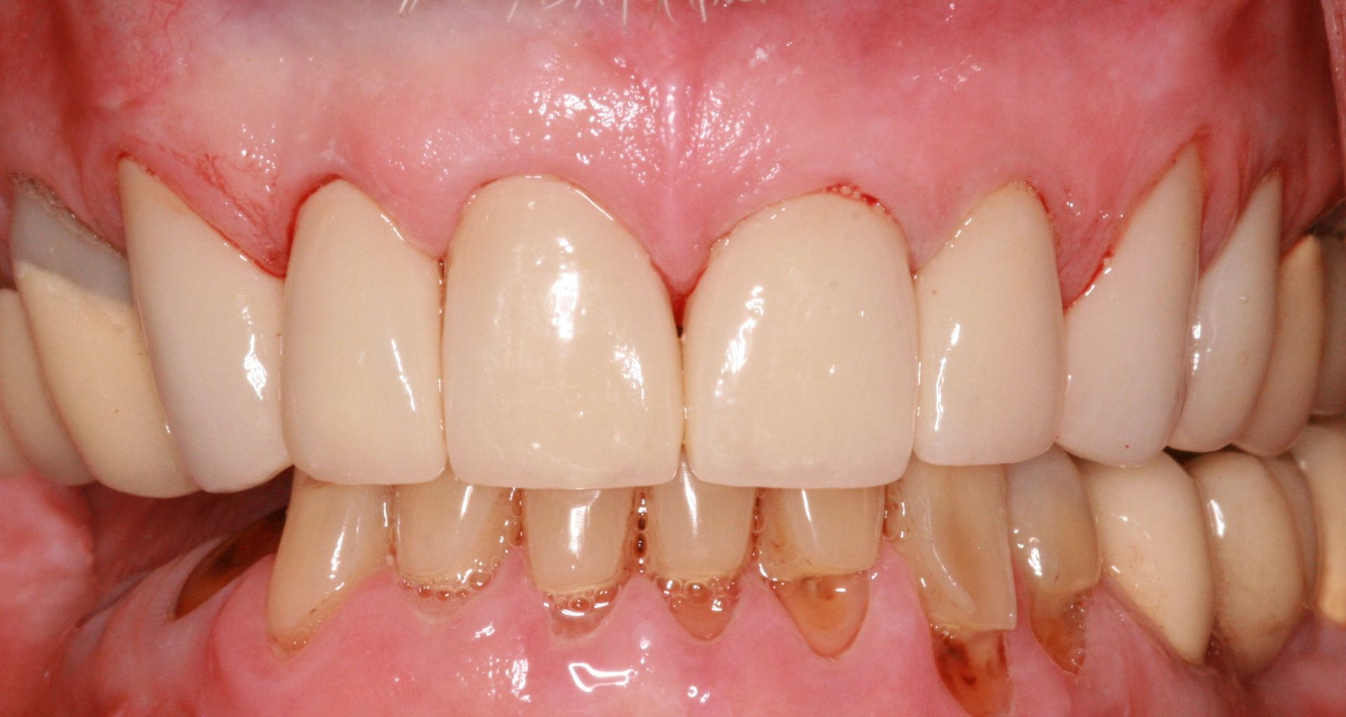 A close up of a person 's teeth with a missing tooth.