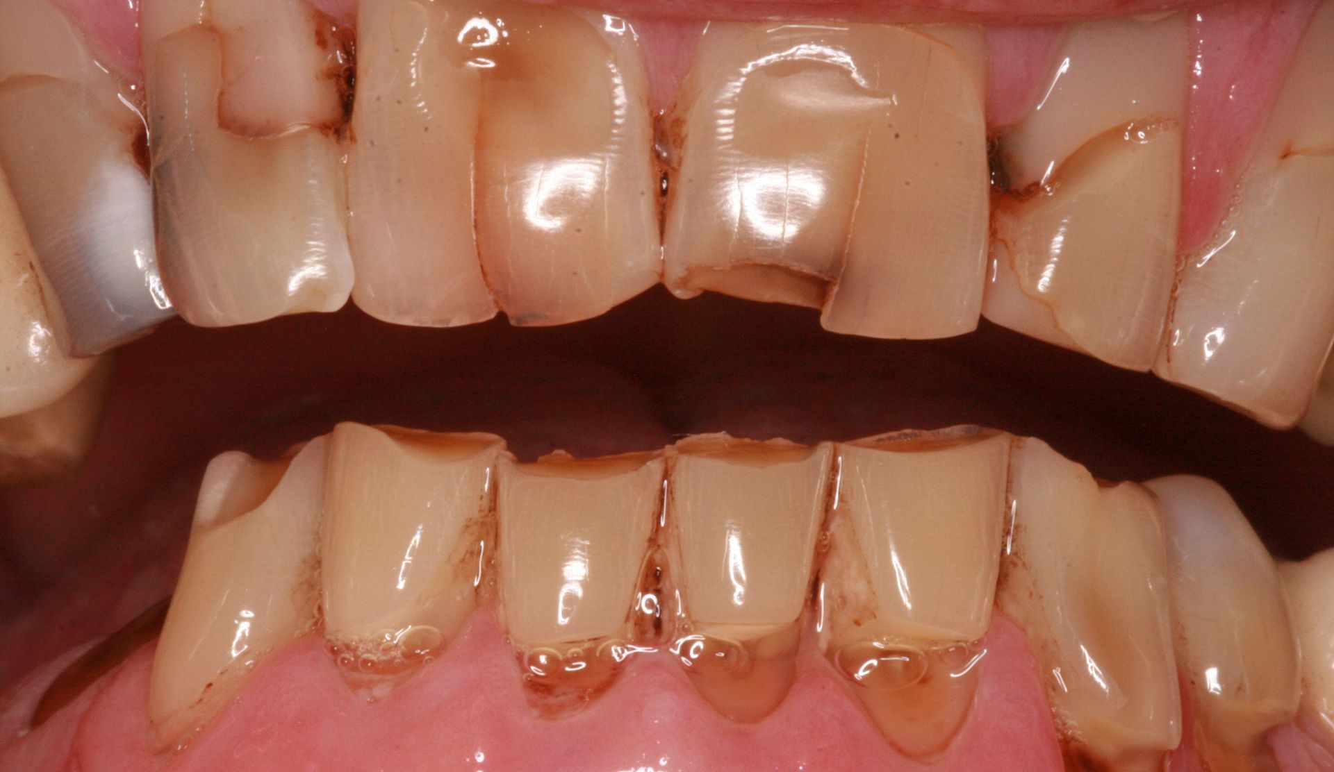 A close up of a person 's teeth with a lot of stains on them.
