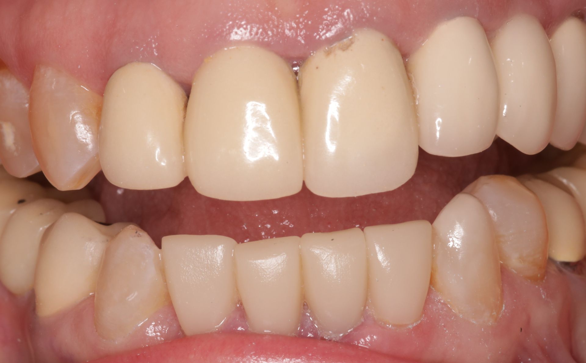A close up of a person 's teeth with white teeth.