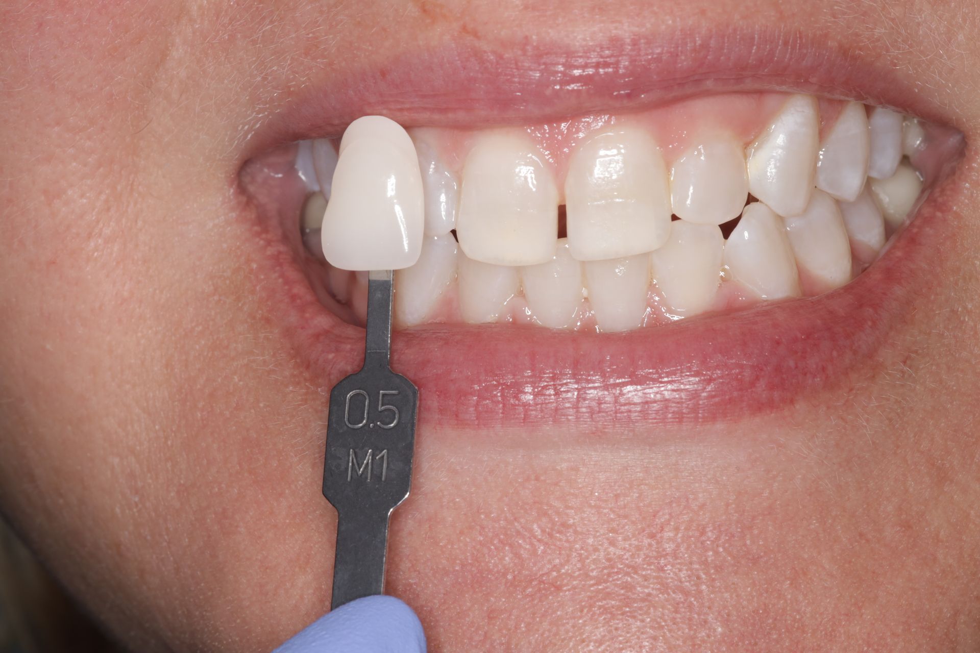 A close up of a woman 's teeth with a tooth shade in her mouth.